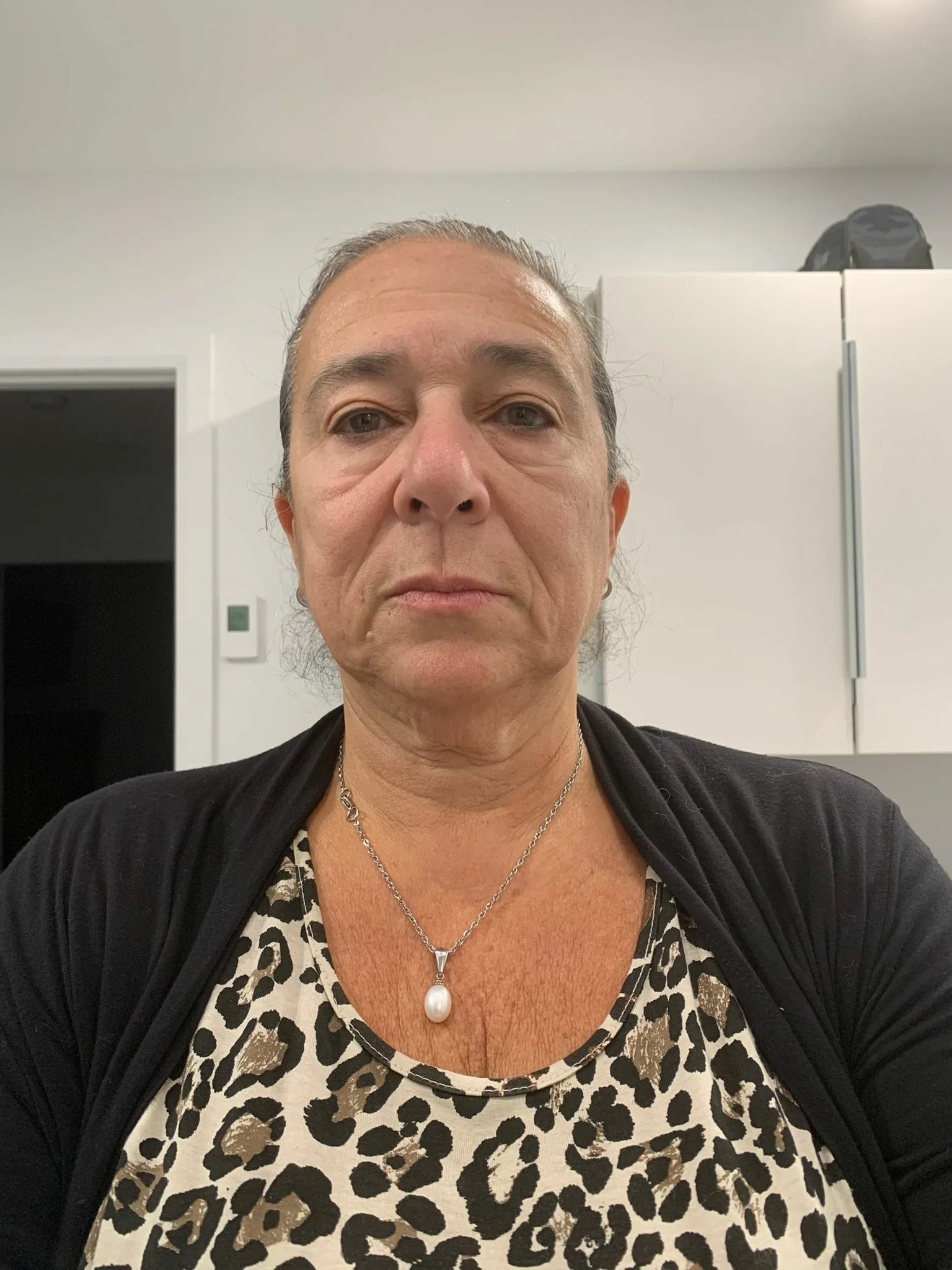 IMG 6082 Deep Plane Facelift & Neck Lift Before and After Result