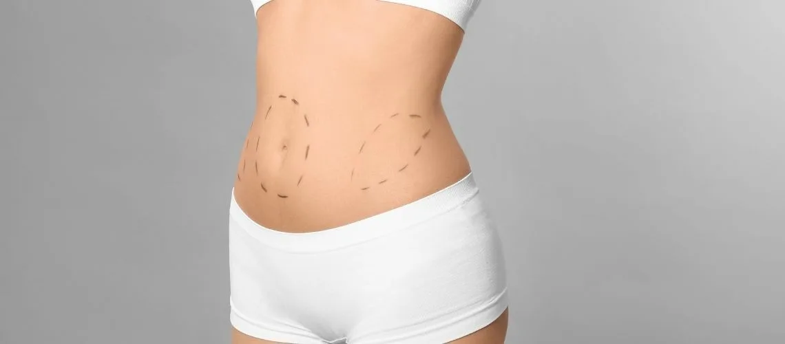 Tummy Tuck and Lipo Buikwandcorrectie en Liposuctie