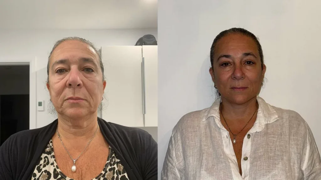 facelift before after photo Deep Plane Facelift & Neck Lift Before and After Result