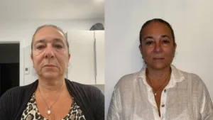 facelift before after photo Deep Plane Facelift & Neck Lift Before and After Result