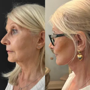 Revision Deep Plane Facelift and Deep Neck Lift in a Female Patient