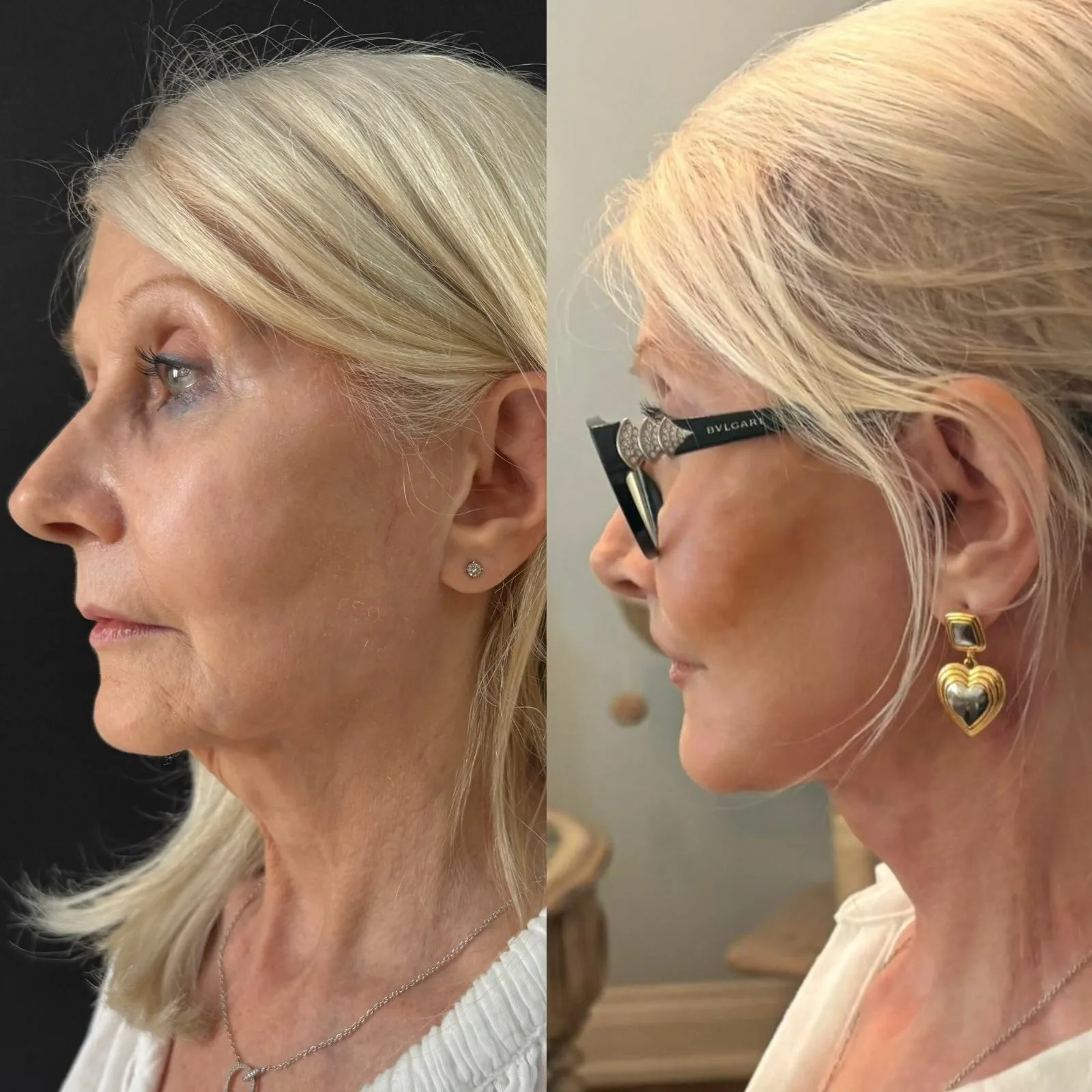 Revision Deep Plane Facelift and Deep Neck Lift in a Female Patient