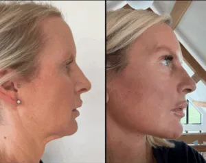 Deep Plane Facelift Combined with Deep Neck Reduction