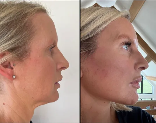 Deep Plane Facelift Combined with Deep Neck Reduction