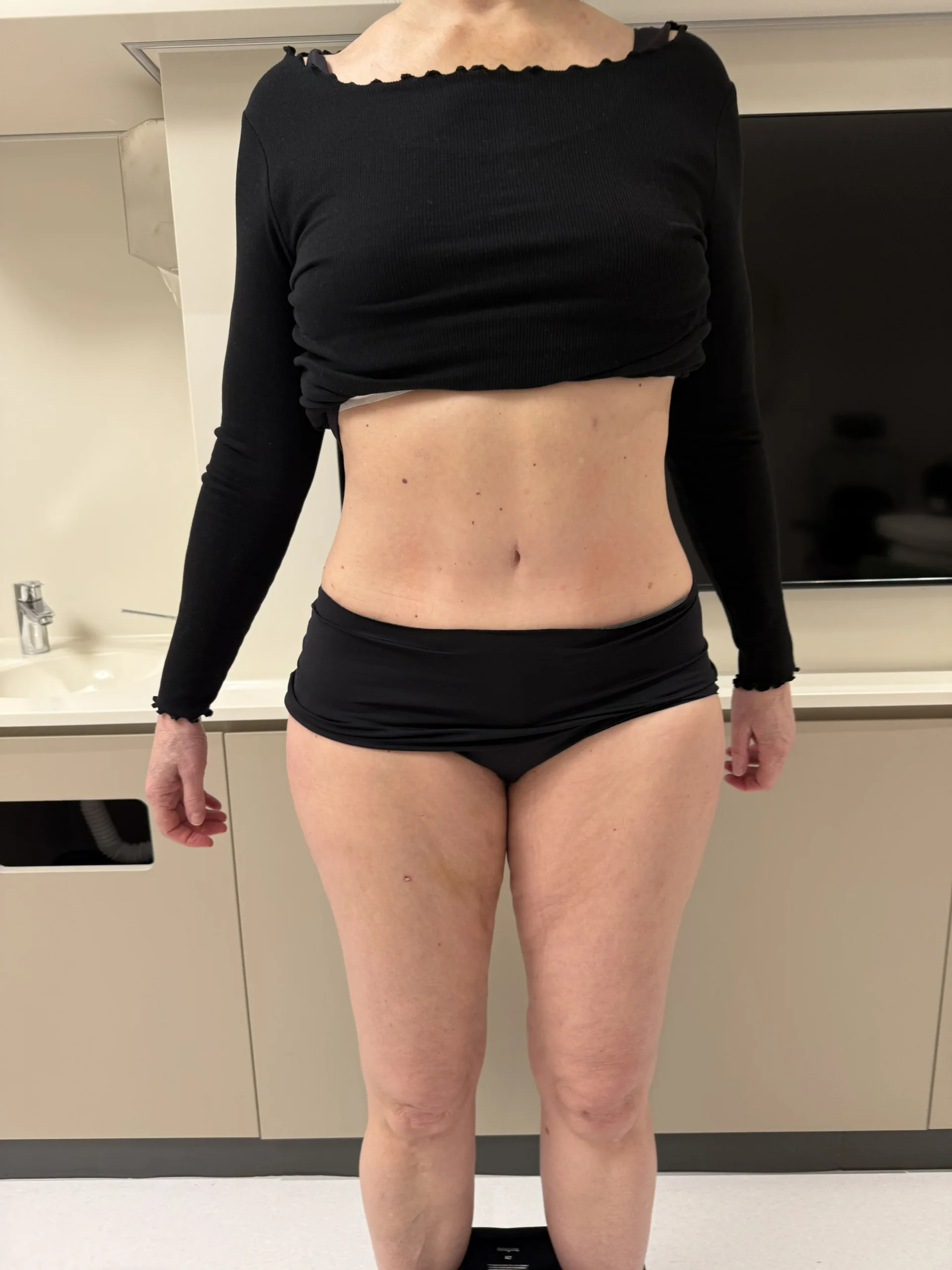 IMG 3069 1 scaled Tummy Tuck and Liposuction Surgery Result in Istanbul, Turkey