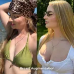 Breast Augmentation with 340 cc Implants – Before and After Result 1 Breast Augmentation with 340 cc Implants – Before and After Result 1 Breast Augmentation with 340 cc Implants – Before and After Result