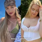 Breast Augmentation with 340 cc Implants – Before and After Result 2 Breast Augmentation with 340 cc Implants – Before and After Result 4 Breast Augmentation with 340 cc Implants – Before and After Result