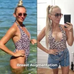 Breast Augmentation with 400 cc High-Profile Implants Before and After 6 Breast Augmentation with 400 cc High Profile Implants Before and After 1 Breast Augmentation with 400 cc High-Profile Implants Before and After