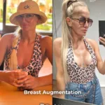 Breast Augmentation with 400 cc High-Profile Implants Before and After 1 Breast Augmentation with 400 cc High Profile Implants Before and After 6 Breast Augmentation with 400 cc High-Profile Implants Before and After