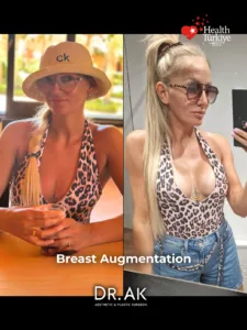 Breast Augmentation with 400 cc High Profile Implants Before and After 6 Breast Augmentation with 400 cc High-Profile Implants Before and After