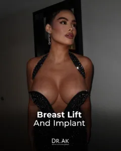 Breast Lift with 475 cc Moderate-Profile Implants Before and After 4 Breast Lift with 475 cc Moderate Profile Implants Before and After 1 Breast Lift with 475 cc Moderate-Profile Implants Before and After