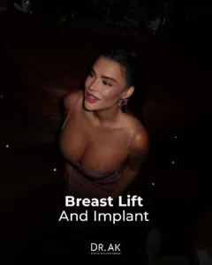 Breast Lift with 475 cc Moderate-Profile Implants Before and After 1 Breast Lift with 475 cc Moderate Profile Implants Before and After 4 Breast Lift with 475 cc Moderate-Profile Implants Before and After