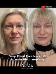Deep Plane Face and Neck Lift with Brow Lift Lower Eyelid Surgery and Fat Transfer Before and After 1 Deep Plane Face and Neck Lift with Brow Lift, Lower Eyelid Surgery and Fat Transfer Before and After