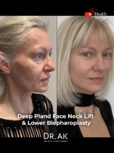 Deep Plane Face and Neck Lift with Brow Lift Lower Eyelid Surgery and Fat Transfer Before and After 2 Deep Plane Face and Neck Lift with Brow Lift, Lower Eyelid Surgery and Fat Transfer Before and After