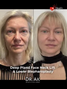 Deep Plane Face and Neck Lift with Brow Lift Lower Eyelid Surgery and Fat Transfer Before and After 3 Deep Plane Face and Neck Lift with Brow Lift, Lower Eyelid Surgery and Fat Transfer Before and After