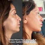Deep Plane Face and Neck Lift with Brow Lift, Lower Eyelid Surgery and Fat Transfer – 4-Month Result 1 Deep Plane Face and Neck Lift with Brow Lift Lower Eyelid Surgery and Fat Transfer – 4 Month Result 1 Deep Plane Face and Neck Lift with Brow Lift, Lower Eyelid Surgery and Fat Transfer – 4-Month Result