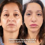 Deep Plane Face and Neck Lift with Brow Lift, Lower Eyelid Surgery and Fat Transfer – 4-Month Result 2 Deep Plane Face and Neck Lift with Brow Lift Lower Eyelid Surgery and Fat Transfer – 4 Month Result 2 Deep Plane Face and Neck Lift with Brow Lift, Lower Eyelid Surgery and Fat Transfer – 4-Month Result
