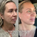 Deep Plane Face and Neck Lift with Brow Lift, Upper Eyelid Surgery, Fat Transfer and CO2 Laser Before and After 1 Deep Plane Face and Neck Lift with Brow Lift Upper Eyelid Surgery Fat Transfer and CO2 Laser Before and After 1 Deep Plane Face and Neck Lift with Brow Lift, Upper Eyelid Surgery, Fat Transfer and CO2 Laser Before and After