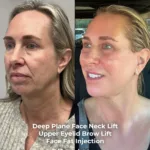 Deep Plane Face and Neck Lift with Brow Lift, Upper Eyelid Surgery, Fat Transfer and CO2 Laser Before and After 2 Deep Plane Face and Neck Lift with Brow Lift Upper Eyelid Surgery Fat Transfer and CO2 Laser Before and After 2 Deep Plane Face and Neck Lift with Brow Lift, Upper Eyelid Surgery, Fat Transfer and CO2 Laser Before and After
