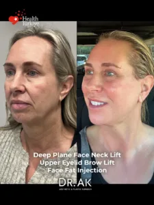 Deep Plane Face and Neck Lift with Brow Lift Upper Eyelid Surgery Fat Transfer and CO2 Laser Before and After 2 Deep Plane Face and Neck Lift with Brow Lift, Upper Eyelid Surgery, Fat Transfer and CO2 Laser Before and After