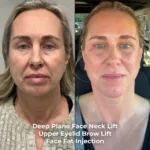 Deep Plane Face and Neck Lift with Brow Lift, Upper Eyelid Surgery, Fat Transfer and CO2 Laser Before and After 3 Deep Plane Face and Neck Lift with Brow Lift Upper Eyelid Surgery Fat Transfer and CO2 Laser Before and After 3 Deep Plane Face and Neck Lift with Brow Lift, Upper Eyelid Surgery, Fat Transfer and CO2 Laser Before and After