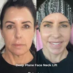 Deep Plane Face and Neck Lift with Upper Eyelid Surgery, Brow Lift and Facial Fat Transfer 2 Deep Plane Face and Neck Lift with Upper Eyelid Surgery Brow Lift and Facial Fat Transfer 1 Deep Plane Face and Neck Lift with Upper Eyelid Surgery, Brow Lift and Facial Fat Transfer