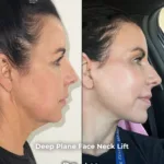 Deep Plane Face and Neck Lift with Upper Eyelid Surgery, Brow Lift and Facial Fat Transfer 1 Deep Plane Face and Neck Lift with Upper Eyelid Surgery Brow Lift and Facial Fat Transfer 2 Deep Plane Face and Neck Lift with Upper Eyelid Surgery, Brow Lift and Facial Fat Transfer