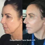 Deep Plane Face and Neck Lift with Upper Eyelid Surgery, Brow Lift and Facial Fat Transfer 3 Deep Plane Face and Neck Lift with Upper Eyelid Surgery Brow Lift and Facial Fat Transfer 3 Deep Plane Face and Neck Lift with Upper Eyelid Surgery, Brow Lift and Facial Fat Transfer