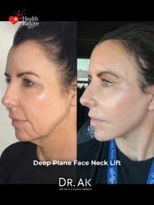 Deep Plane Face and Neck Lift with Upper Eyelid Surgery Brow Lift and Facial Fat Transfer 3 Deep Plane Face and Neck Lift with Upper Eyelid Surgery, Brow Lift and Facial Fat Transfer