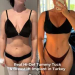Extended Tummy Tuck, Liposuction and Breast Lift with Implants Before and After 2 Extended Tummy Tuck Liposuction and Breast Lift with Implants Before and After 1 Extended Tummy Tuck, Liposuction and Breast Lift with Implants Before and After