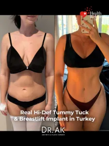 Extended Tummy Tuck Liposuction and Breast Lift with Implants Before and After 1 Extended Tummy Tuck, Liposuction and Breast Lift with Implants Before and After