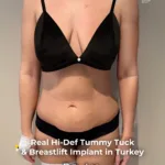 Extended Tummy Tuck, Liposuction and Breast Lift with Implants Before and After 3 Extended Tummy Tuck Liposuction and Breast Lift with Implants Before and After 2 Extended Tummy Tuck, Liposuction and Breast Lift with Implants Before and After