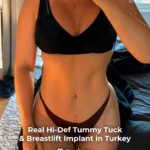Extended Tummy Tuck, Liposuction and Breast Lift with Implants Before and After 1 Extended Tummy Tuck Liposuction and Breast Lift with Implants Before and After 3 Extended Tummy Tuck, Liposuction and Breast Lift with Implants Before and After
