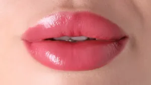 Lip Lift Dudak Kaldirma Ameliyati Olanlarin Yorumlari Lip Lift (Dudak Kaldırma) Ameliyatı Olanların Yorumları