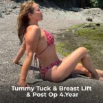 Tummy Tuck Revision, Liposuction and Breast Lift Before and After 1 Tummy Tuck Revision Liposuction and Breast Lift Before and After 1 Tummy Tuck Revision, Liposuction and Breast Lift Before and After