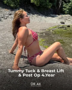 Tummy Tuck Revision Liposuction and Breast Lift Before and After 1 Tummy Tuck Revision, Liposuction and Breast Lift Before and After