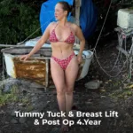 Tummy Tuck Revision, Liposuction and Breast Lift Before and After 3 Tummy Tuck Revision Liposuction and Breast Lift Before and After 2 Tummy Tuck Revision, Liposuction and Breast Lift Before and After
