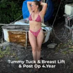Tummy Tuck Revision, Liposuction and Breast Lift Before and After 2 Tummy Tuck Revision Liposuction and Breast Lift Before and After 3 Tummy Tuck Revision, Liposuction and Breast Lift Before and After